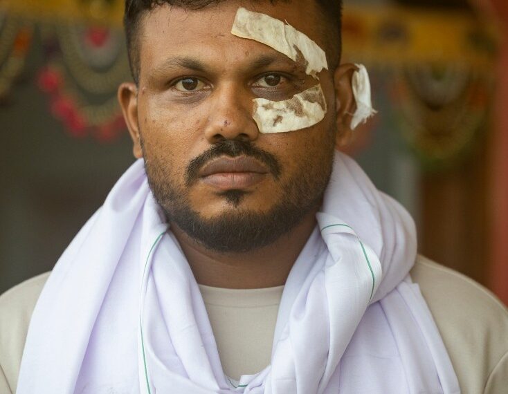 El único sobreviviente de un accidente aéreo de Air India con vendas en su rostro.