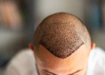 Vista superior del cuero cabelludo de un hombre después de un trasplante de cabello.