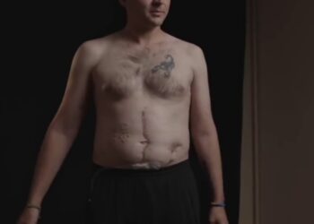 Ucrania reveló la tortura de descarga eléctrica soportada por Pow Andriy Perverzev, quien fue marcada con "Gloria a Rusia" en su abdomen mientras está en cautiverio.