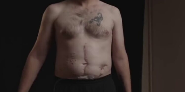 Ucrania reveló la tortura de descarga eléctrica soportada por Pow Andriy Perverzev, quien fue marcada con "Gloria a Rusia" en su abdomen mientras está en cautiverio.