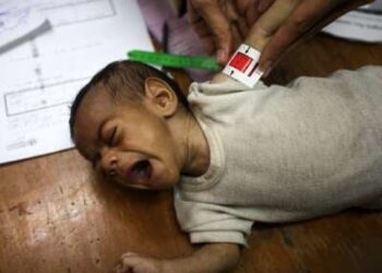 Una niña palestina sufre de desnutrición y se mide mientras recibe tratamiento en el hospital de la Asociación de Amigos de Pacientes en la ciudad de Gaza, el 22 de julio de 2025.