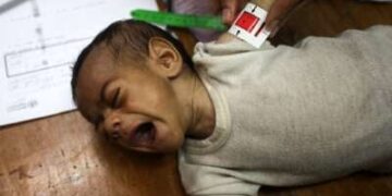 Una niña palestina sufre de desnutrición y se mide mientras recibe tratamiento en el hospital de la Asociación de Amigos de Pacientes en la ciudad de Gaza, el 22 de julio de 2025.