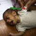 Una niña palestina sufre de desnutrición y se mide mientras recibe tratamiento en el hospital de la Asociación de Amigos de Pacientes en la ciudad de Gaza, el 22 de julio de 2025.