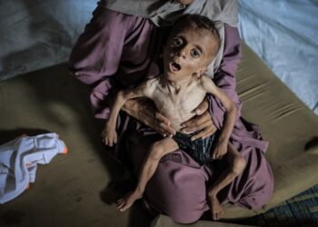 Niño severamente desnutrido sostenido por una mujer.