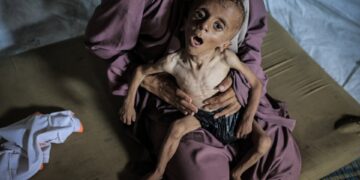 Niño severamente desnutrido sostenido por una mujer.