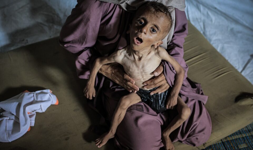 Niño severamente desnutrido sostenido por una mujer.