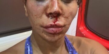 Foto de primer plano de una mujer con graves lesiones faciales.