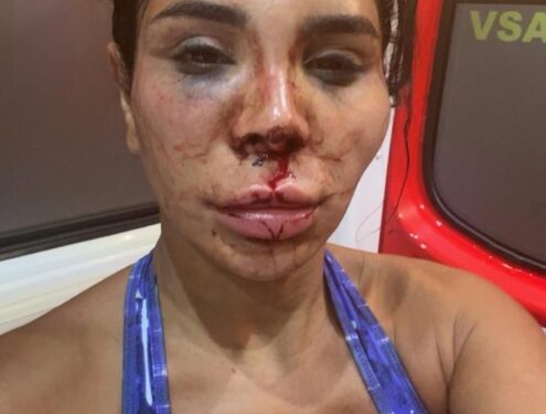 Foto de primer plano de una mujer con graves lesiones faciales.