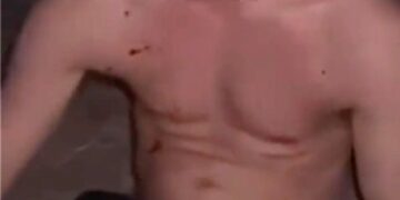 Un joven con sangre en su torso después de ser agredido.