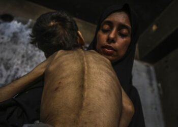 Niño desnutrido sostenido por una mujer.