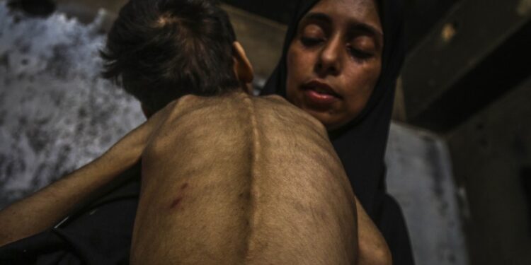 Niño desnutrido sostenido por una mujer.