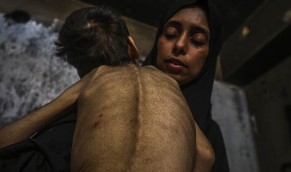 Niño desnutrido sostenido por una mujer.