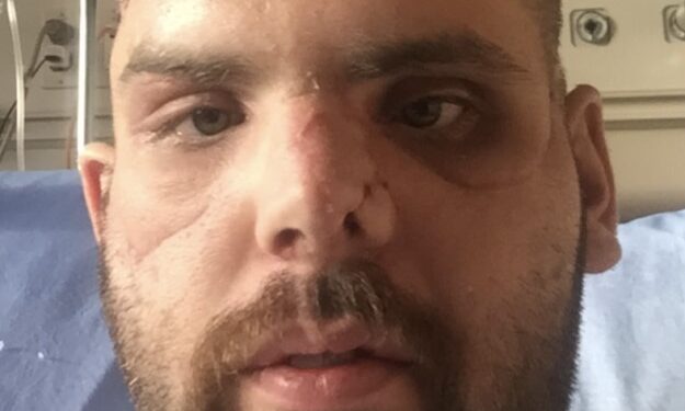 Hombre con graves lesiones faciales por un ataque de oso pardo.