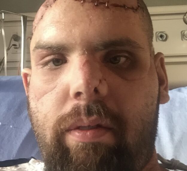 Hombre con graves lesiones faciales por un ataque de oso pardo.