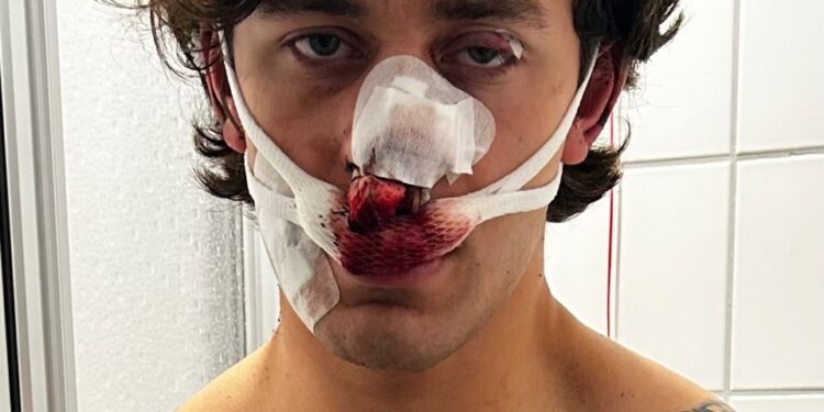 Hombre con lesiones faciales graves y vendajes empapados de sangre.