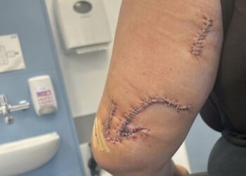 El brazo de Samantha Shaw, de 19 años, en un hospital con cortes en su cuerpo de una botella de vidrio.
