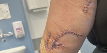 El brazo de Samantha Shaw, de 19 años, en un hospital con cortes en su cuerpo de una botella de vidrio.
