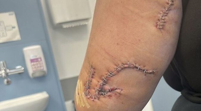 El brazo de Samantha Shaw, de 19 años, en un hospital con cortes en su cuerpo de una botella de vidrio.