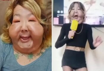 El influencer idiota apodado el Popeye ruso se enfrenta a perder AMBOS brazos después de bombearlos con un cóctel sombrío para darle unos bíceps enormes