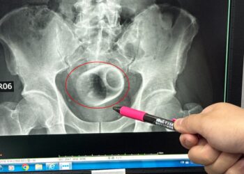 Encuentran una taza de té en el trasero de un hombre que fue al hospital quejándose de estreñimiento