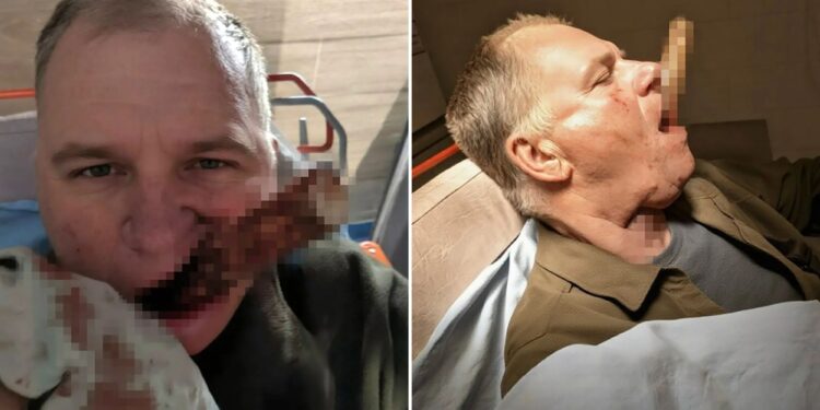 Un collage de imágenes que contiene 2 imágenes. La imagen 1 muestra a Nikolai, de 47 años, con el mango de una pala empalado en la cara mientras se lleva un paño ensangrentado a la boca. La imagen 2 muestra a un hombre acostado con el mango de una pala empalado en la boca.