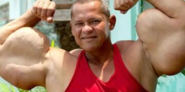 Un collage de imágenes que contiene 1 imágenes. La imagen 1 muestra a un hombre conocido como "popeye brasileño" flexionando los músculos de sus brazos extremadamente grandes