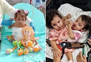 Muere gemelo siames tras operación de urgencia para separarlo de su hermano sin vida días después de un parto de alto riesgo