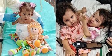 Muere gemelo siames tras operación de urgencia para separarlo de su hermano sin vida días después de un parto de alto riesgo