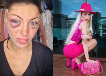 Un collage de imágenes que contiene 2 imágenes. La imagen 1 muestra a una mujer con ojos azules y moretones negros alrededor, usando una prenda de compresión facial. La imagen 2 muestra a Barbara Jankavski Márquez con un traje rosa brillante que incluye sombrero, blusa, falda, zapatos y bolso.