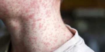 Mientras los casos de sarampión se disparan, los médicos se enfrentan a una enfermedad que pocos han visto antes